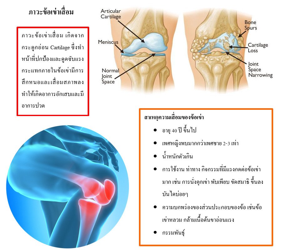 ภาวะข้อเข่าเสื่อม