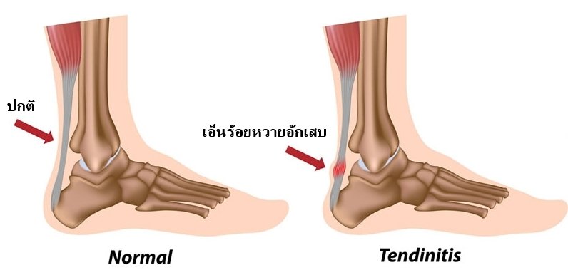 เดิน วิ่งแล้วเจ็บเอ็นร้อยหวาย เป็นอะไรกันแน่