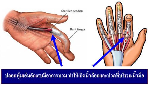 นิ้วล็อค แบบนี้ไม่เลิฟแน่ !!!