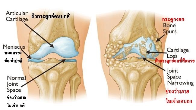 เข่าเสื่อม ไม่อยากผ่า ต้องอ่าน!!