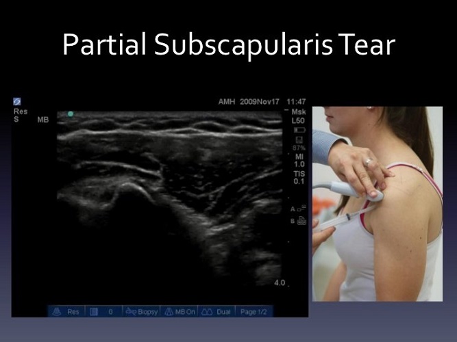 เอ็นข้อไหล่ด้านหน้าอักเสบ (Subscapularis Tendinitis)