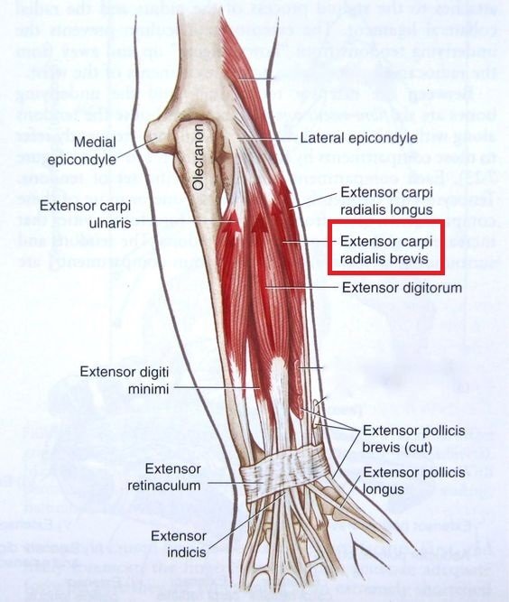 TENNIS ELBOW ปวดศอกด้านนอก อาการที่ไม่ได้เกิดขึ้นเฉพาะกับนักเทนนิส