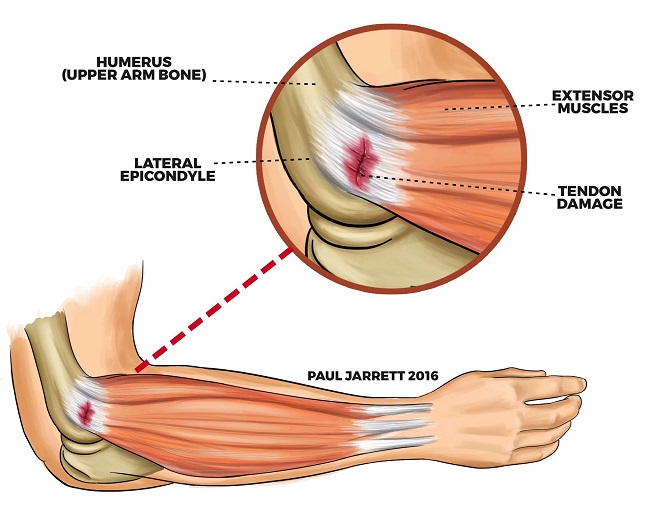 TENNIS ELBOW ปวดศอกด้านนอก อาการที่ไม่ได้เกิดขึ้นเฉพาะกับนักเทนนิส