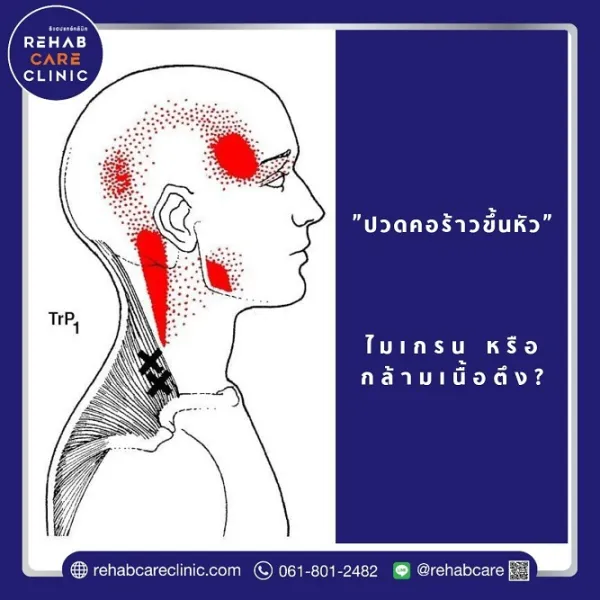 ปวดคอร้าวขึ้นหัว เกิดจากไมเกรนหรือกล้ามเนื้อตึงกันแน่?